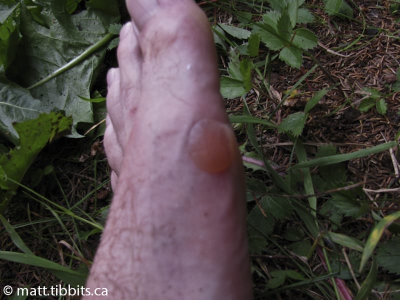 One of many blisters. I named this one "Penelope".